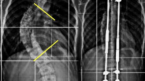Immagine di barre magnetiche impiantate per la correzione della scoliosi