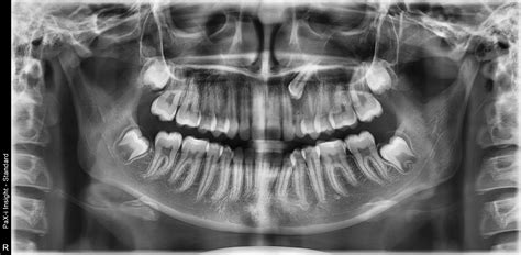 Radiografia ortopanoramica che evidenzia un canino mascellare incluso o dislocato