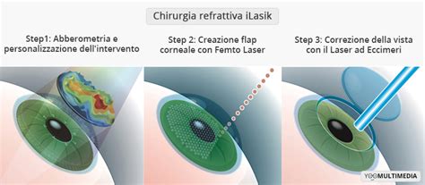 Infografica sulle diverse tecniche di chirurgia refrattiva con laser