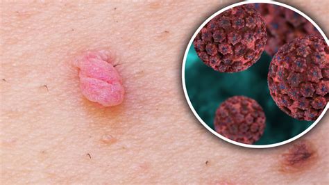Illustrazione delle patologie HPV nell'uomo (condilomi, carcinomi)