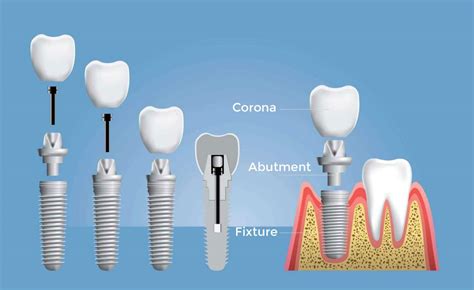 Schema di un impianto dentale
