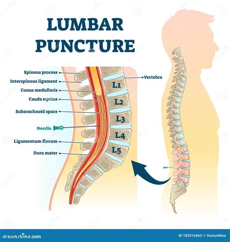 Illustrazione della procedura di puntura lombare