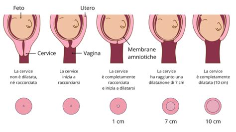 Illustrazione del cerchiaggio cervicale durante la gravidanza