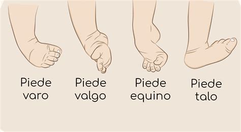 Infografica/Schema del piede torto congenito prima e dopo il trattamento