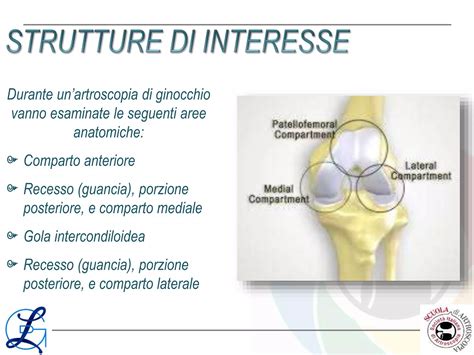 Schema di un'articolazione del ginocchio durante un'artroscopia, mostrando gli strumenti