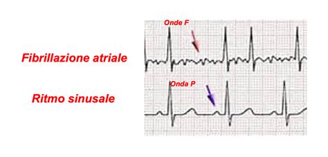 Immagine schematica dell'ablazione per fibrillazione atriale