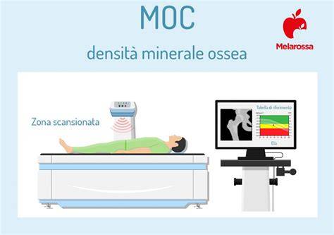 Immagine di una densitometria ossea (MOC)