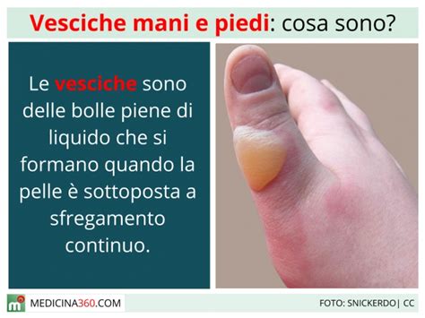 Infografica sulla prevenzione e cura delle vesciche sui piedi