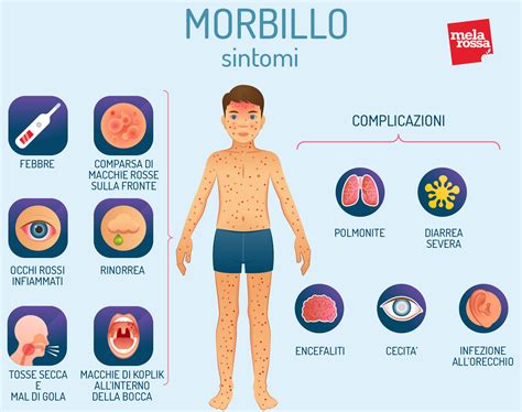 Illustrazione delle fasi di sviluppo dell'esantema da morbillo