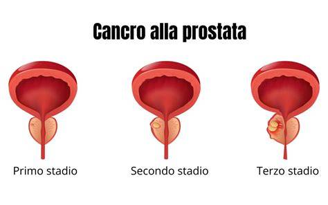 Infografica sulla prevalenza del tumore alla prostata in Italia e fattori di rischio
