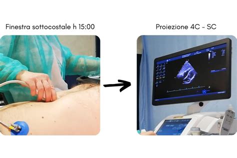 illustrazione di una sonda ecografica su un addome