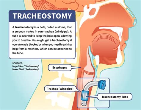 Infographic explaining the tracheostomy procedure and its function in supporting breathing for ALS patients.