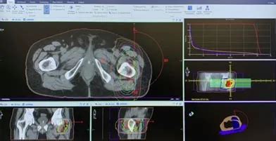 Schema grafico che illustra il funzionamento della radioterapia stereotassica di precisione su un target tumorale