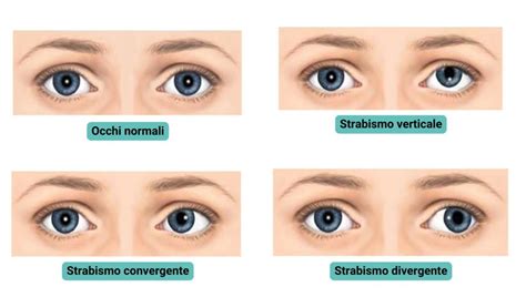 Infografica: Percorso diagnostico per lo strabismo infantile con età e tipologia di esame