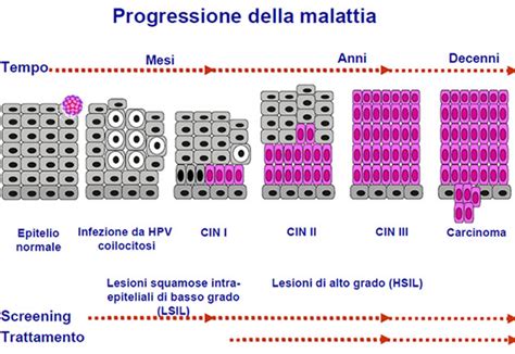 illustrazione scientifica del collo dell'utero e delle cellule anomale rilevate dal Pap test, o infografica sull'importanza della prevenzione del cancro cervicale