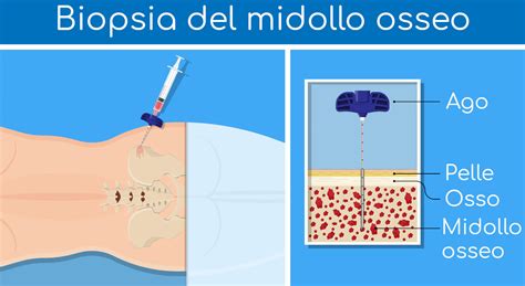 Schema comparativo tra aspirato midollare e biopsia osteomidollare, evidenziando il tipo di campione prelevato e le informazioni ottenibili