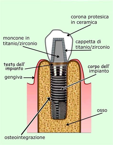 Schema di un impianto dentale inserito nella mascella