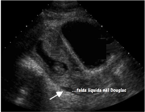Immagine ecografica di falda liquida nello scavo di Douglas