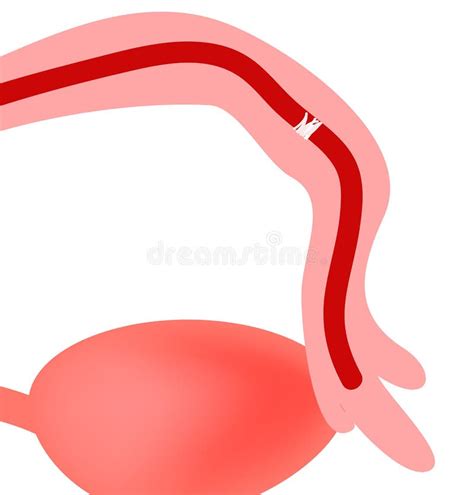 Illustrazione delle tube di Falloppio e dell'utero con accumulo di liquido anomalo