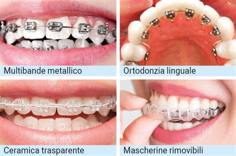 Infografica che mostra diversi tipi di apparecchi ortodontici (tradizionali, invisibili)
