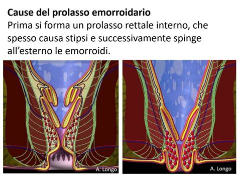 schema delle tecniche chirurgiche per il prolasso rettale