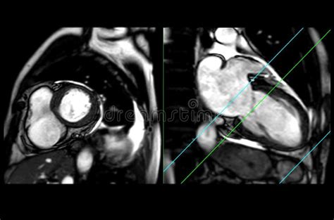 Immagine di ecocardiogramma o risonanza magnetica cardiaca