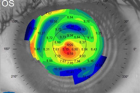 Immagine di una mappa di topografia corneale che mostra le variazioni di curvatura della cornea.