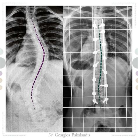 Schema di un intervento chirurgico per la correzione della scoliosi con barre magnetiche