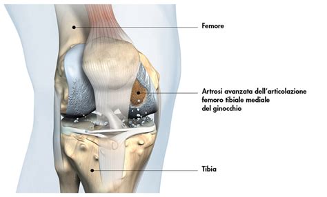 Infografica sulla tecnica di chirurgia rigenerativa del ginocchio con tessuto adiposo