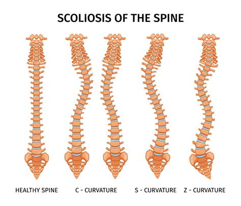Schema illustrativo della scoliosi o di un sistema di correzione vertebrale pediatrica