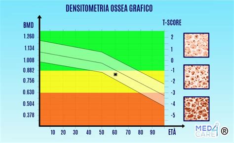 grafico illustrativo sulla densità ossea e i fattori di rischio dell'osteoporosi