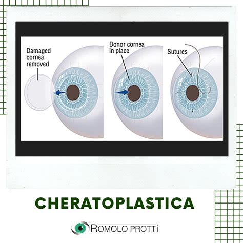 Diagramma che illustra un intervento chirurgico di trapianto di cornea
