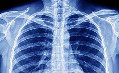 radiografia del torace di un paziente con ARDS, mostrando un aspetto a 