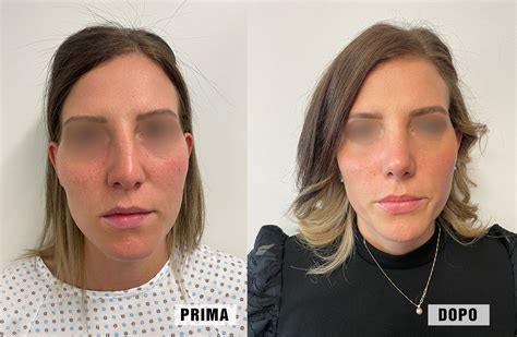 Madonna in un collage di foto prima e dopo i presunti interventi estetici al viso