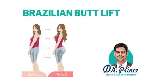 Illustrazione schematica del procedimento del Brazilian Butt Lift (BBL)