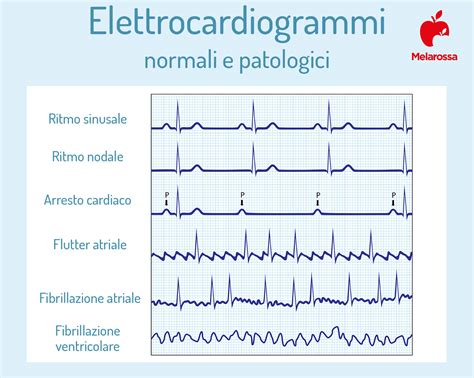 Infografica che mostra l'importanza dell'elettrocardiogramma (ECG) nel monitoraggio cardiaco pediatrico.