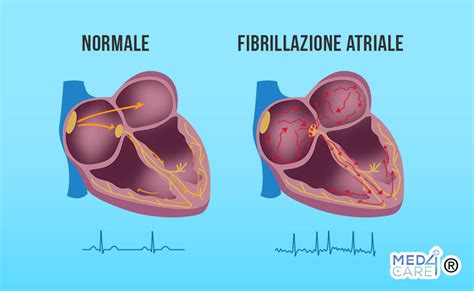 Schema che illustra la distinzione tra aritmie benigne e maligne e le relative manifestazioni cliniche.