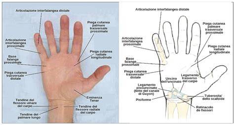 illustrazione anatomica del polso con lo spazio di Destot e il percorso di un chiodo
