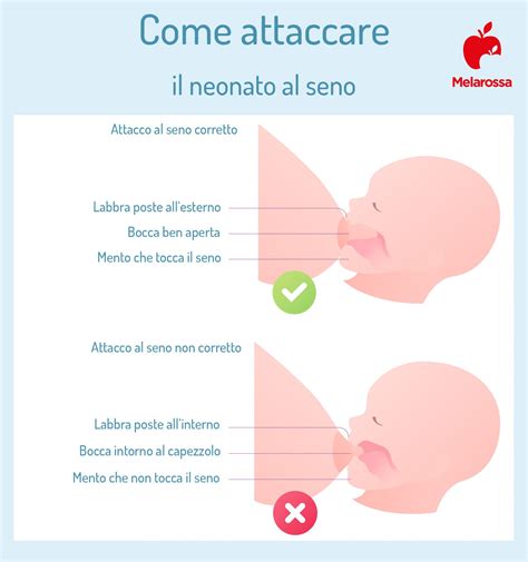 Foto di un neonato che si attacca al seno materno con il supporto del personale ospedaliero