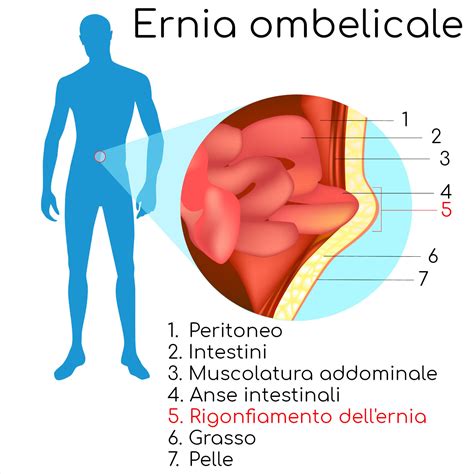 Schema illustrativo delle diverse tipologie di ernia addominale (inguinale, femorale, ombelicale)