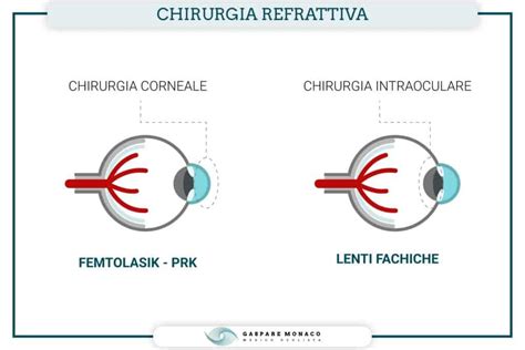 Schema illustrativo delle tecnologie di chirurgia refrattiva utilizzate presso la sala operatoria del Centro Europeo