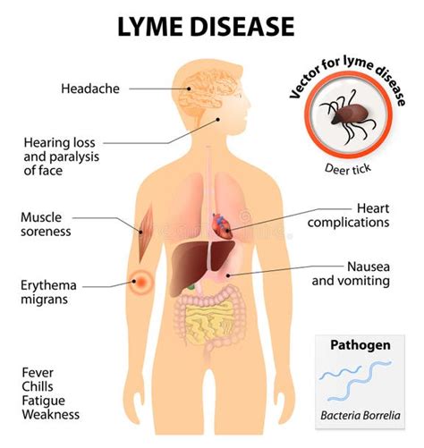 Illustrazione schematica della borreliosi di Lyme
