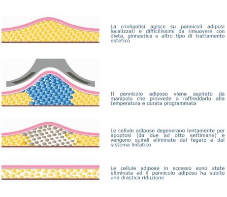 Infografica sulla criolipolisi e il meccanismo di riduzione del grasso tramite raffreddamento
