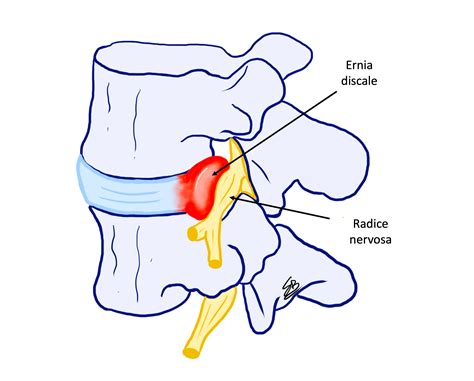 Schema anatomico della colonna vertebrale con evidenziazione di ernia discale