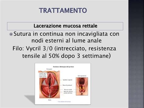 schema delle diverse tipologie di lacerazioni perineali durante il parto