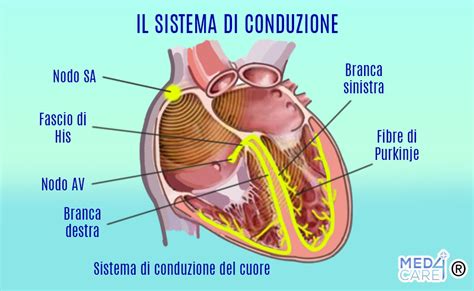 Schema del sistema di conduzione elettrica del cuore e posizionamento dei cateteri per l'ablazione