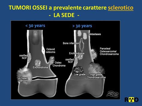 Diagnosi di sarcoma all'osso iliaco sinistro e lesioni ossee
