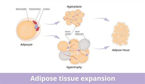 Illustrazione grafica dell'iperplasia adiposa paradossa (paradoxical adipose hyperplasia)