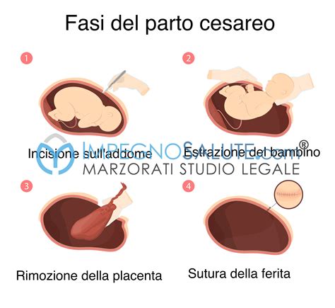 Strumentazione chirurgica per taglio cesareo d'urgenza