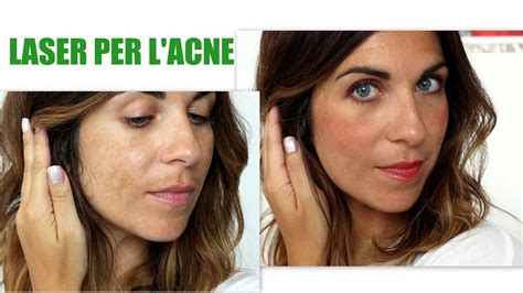 Infografica: Trattamenti laser per cicatrici da acne